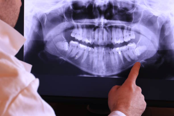 Best Emergency Tooth Extraction in Idalou, TX