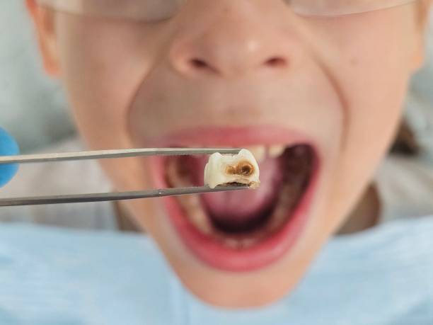 Best Emergency Wisdom Teeth Removal in Idalou, TX